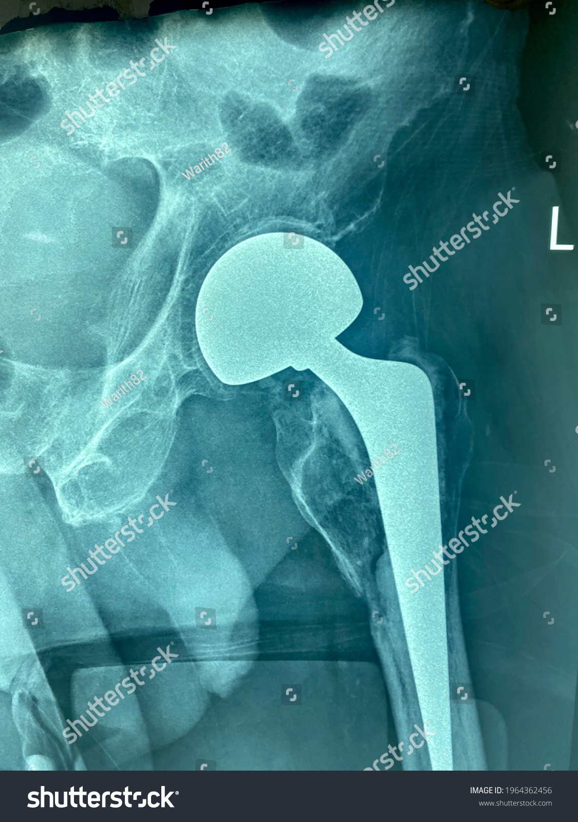 Radiograph Xray Pelvic Hip Displaying Hip Stock Photo Shutterstock