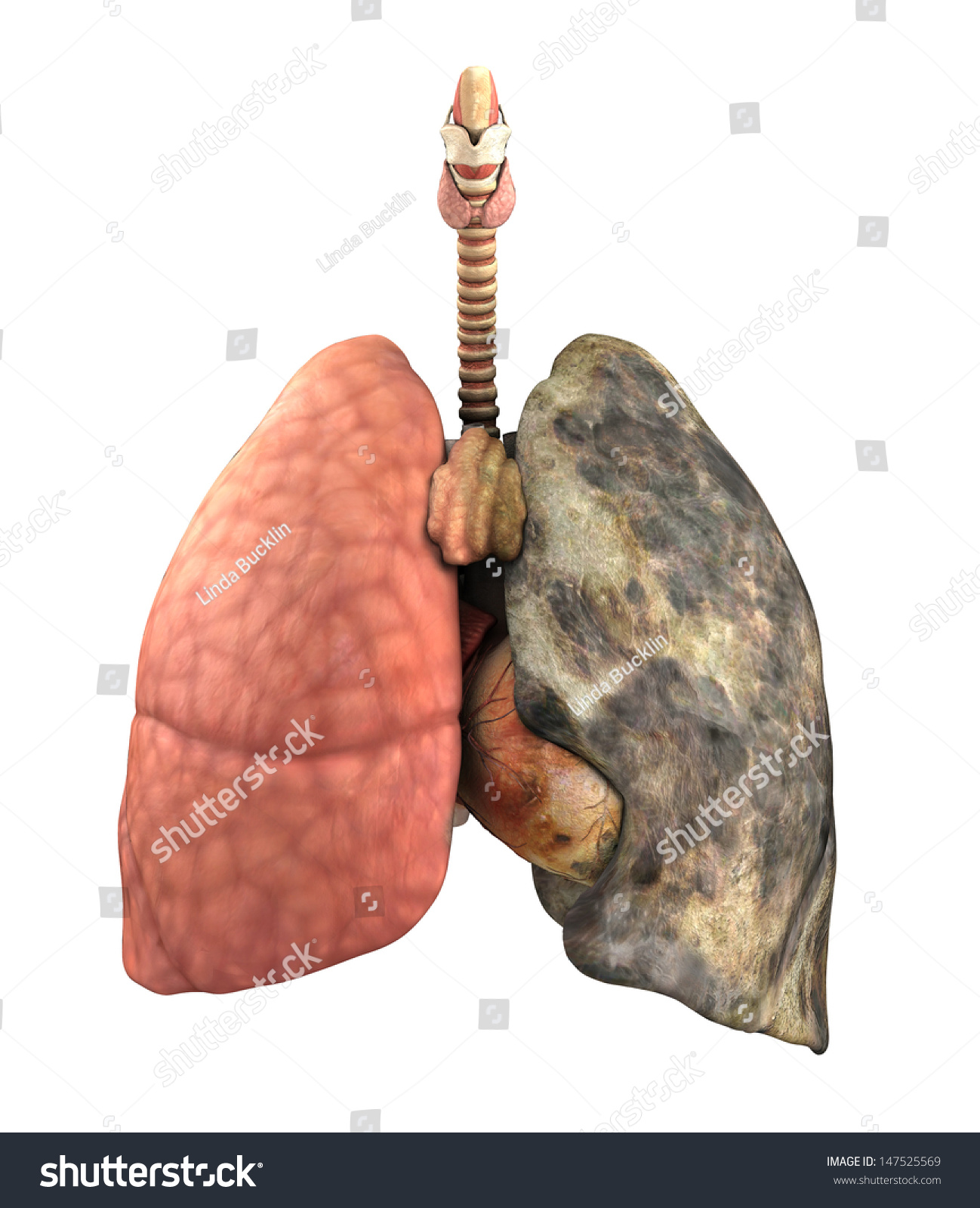 All 90+ Images pictures of smokers’ lungs before and after Sharp