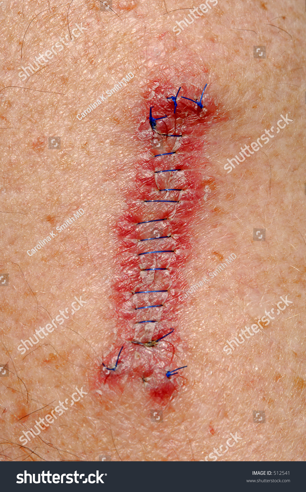 A Wide Local Excision,Arm, 5 Cm, Stitches, To Remove A Malignant ...