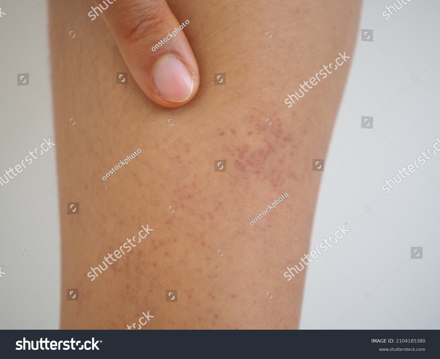 woman-suffering-thrombocytopenia-bleeding-under-skin-stock-photo-edit