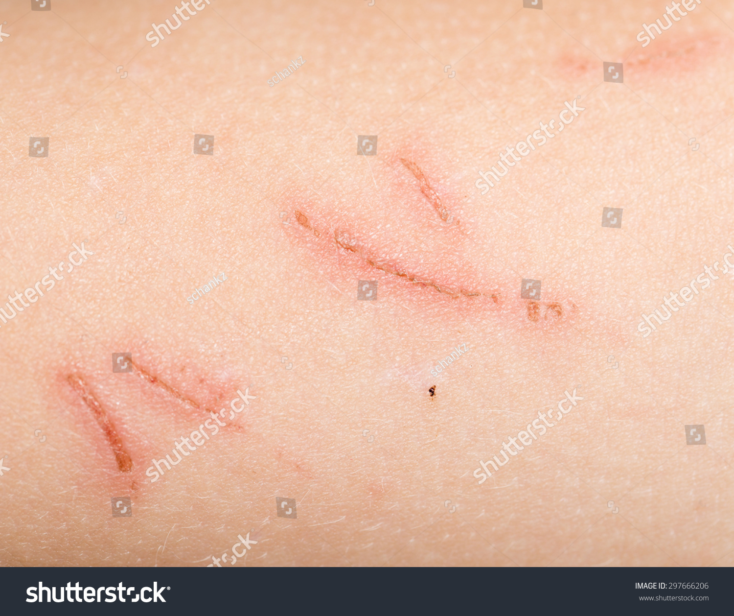 Wound On Skin Close Stock Photo 297666206 - Shutterstock