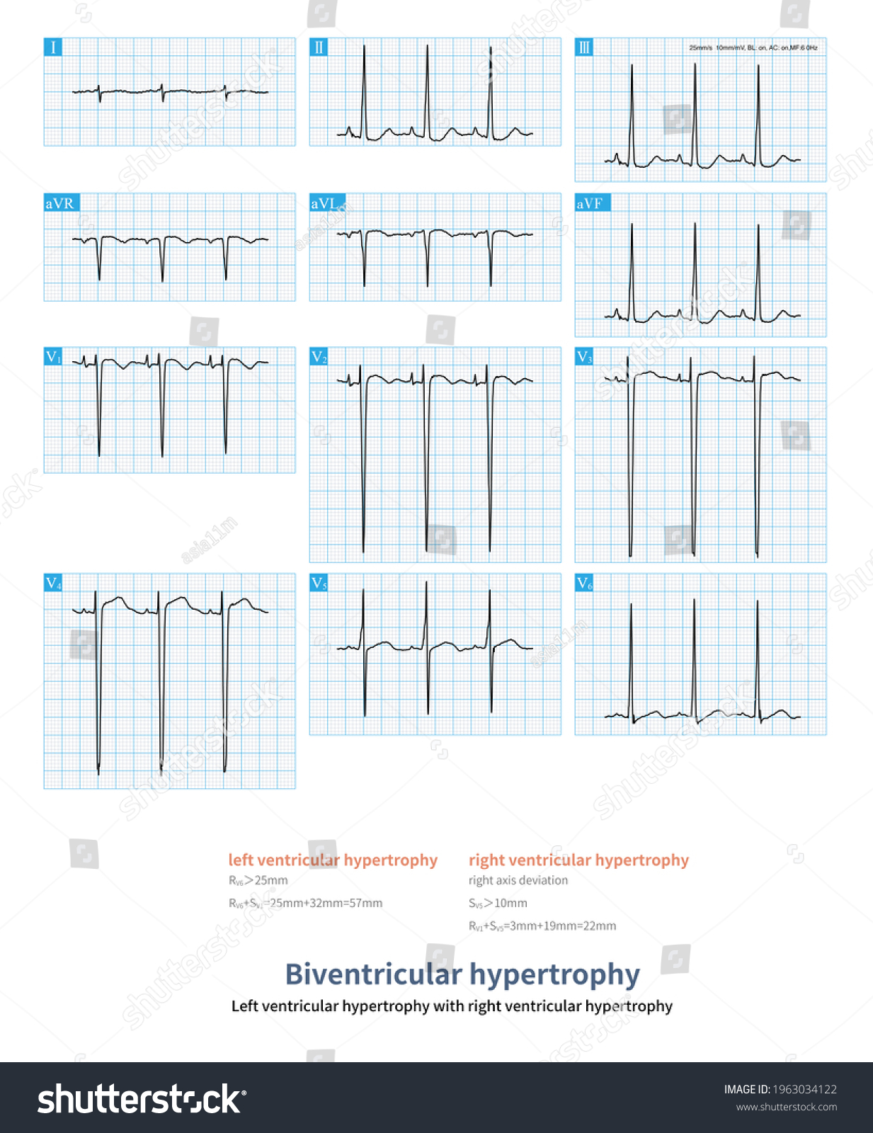 63 Year Old Male Presented Mitral Stock Illustration 1963034122 ...