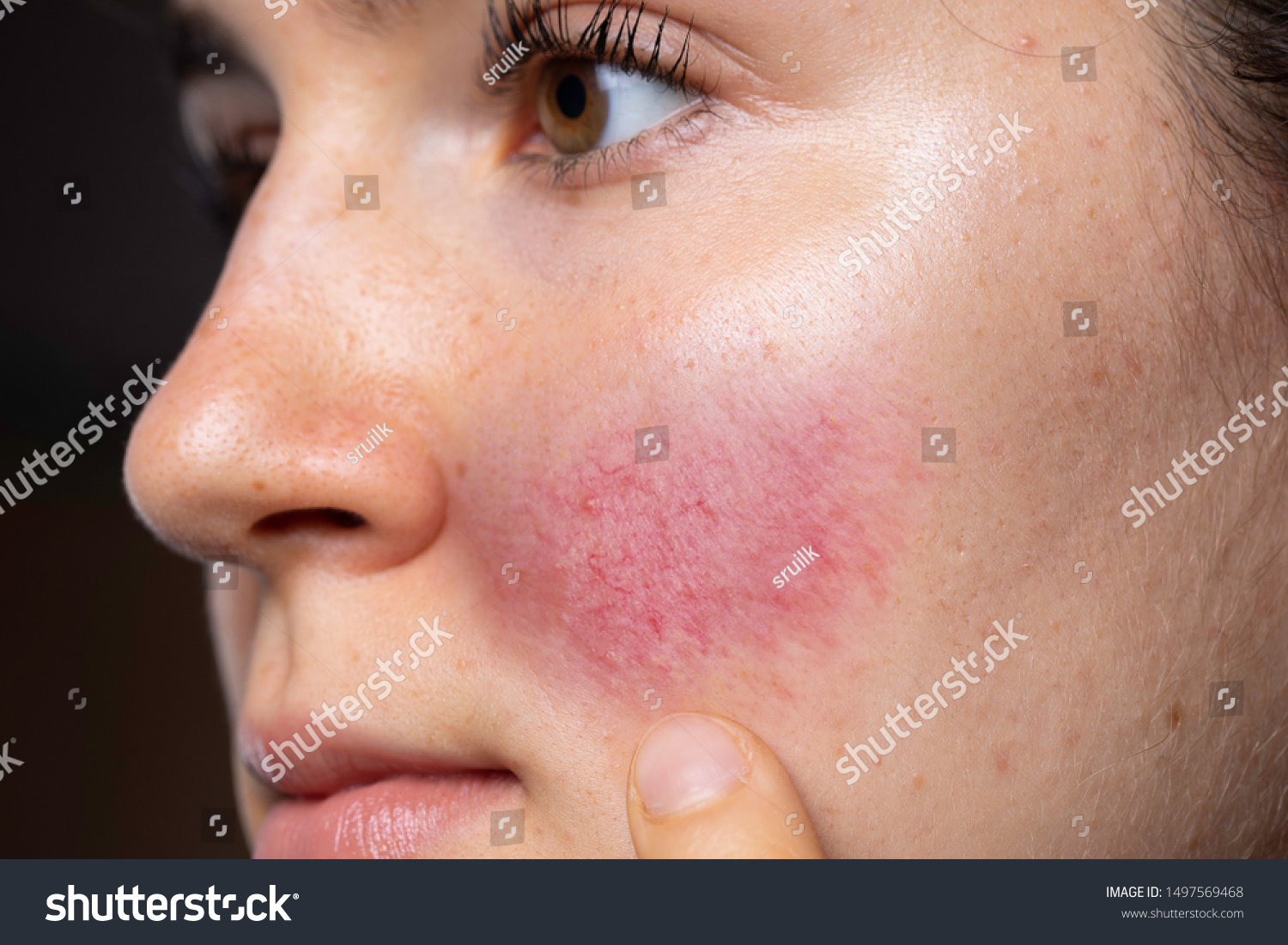 白人の若い女性が 赤い紅潮した頬を指し 血管を拡張し バラケアの徴候を示す の写真素材 今すぐ編集