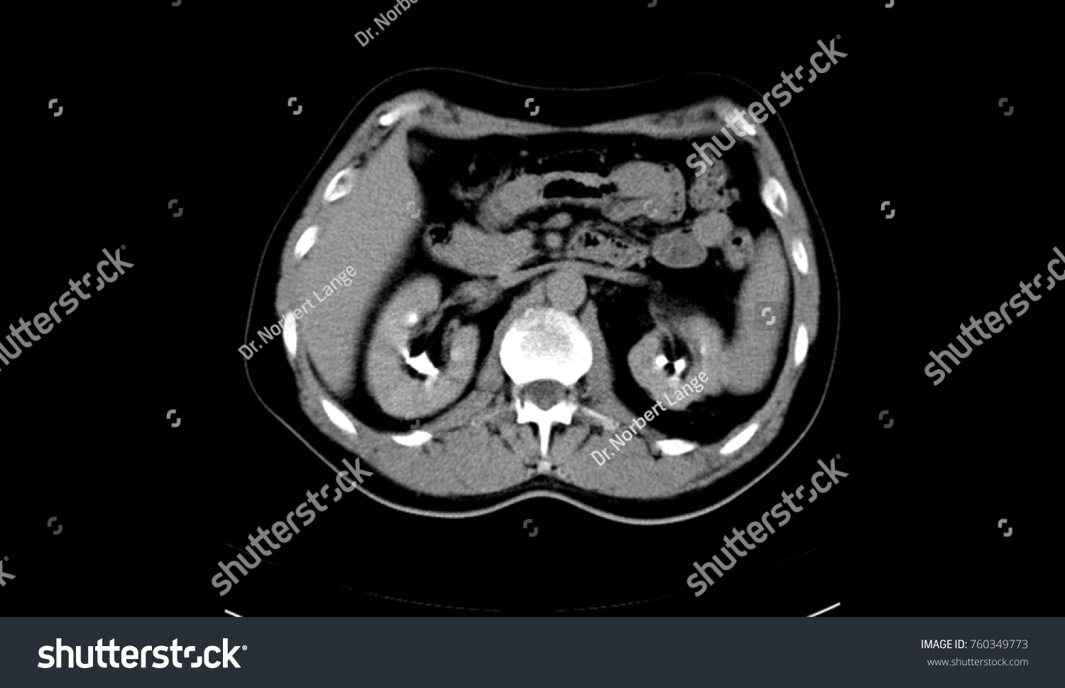 Abdomen Human Man Ct Scan Foto Stok Shutterstock