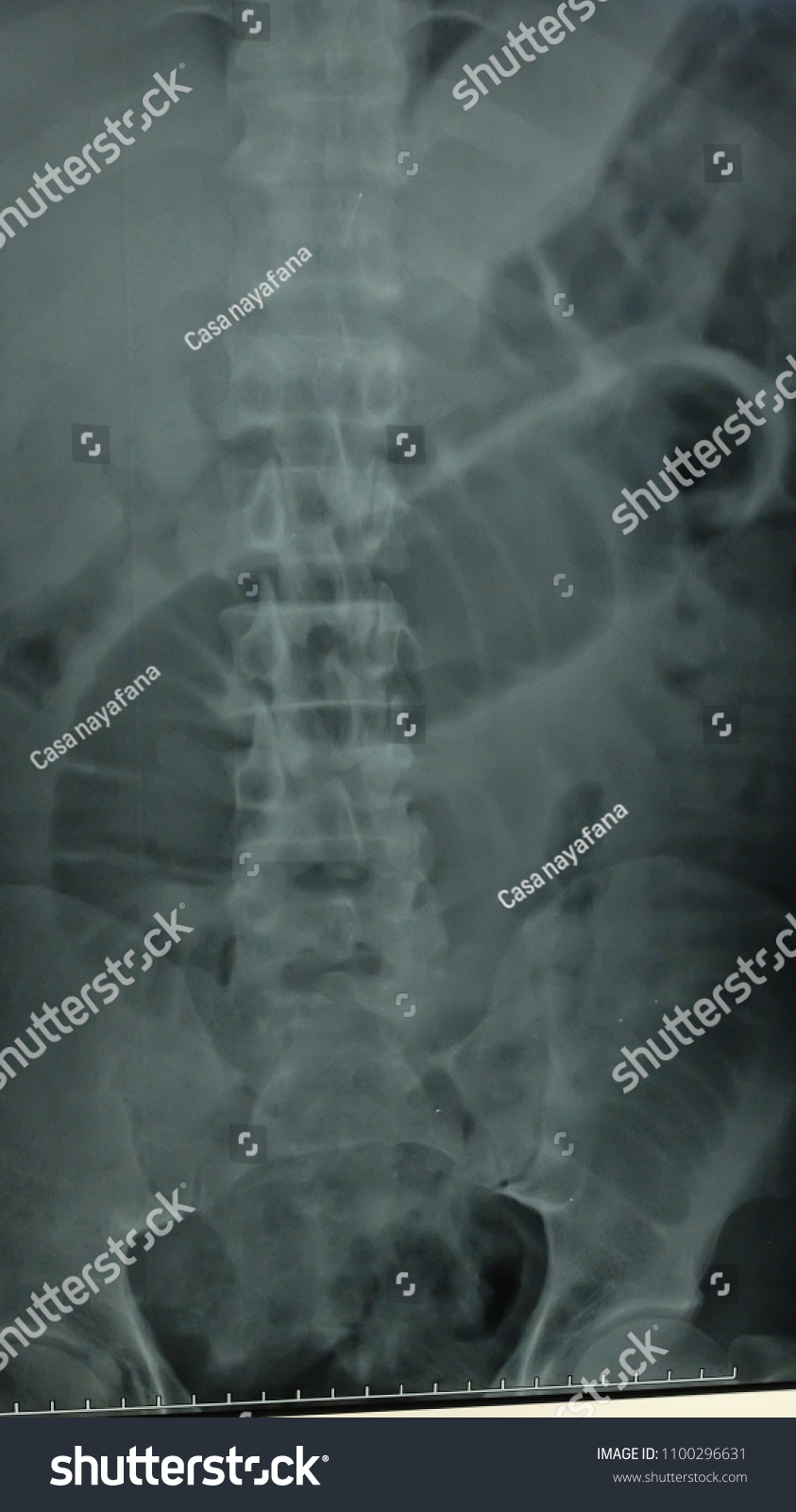 Abdominal Xray Showing Dilated Loop Small Stock Photo 1100296631 ...