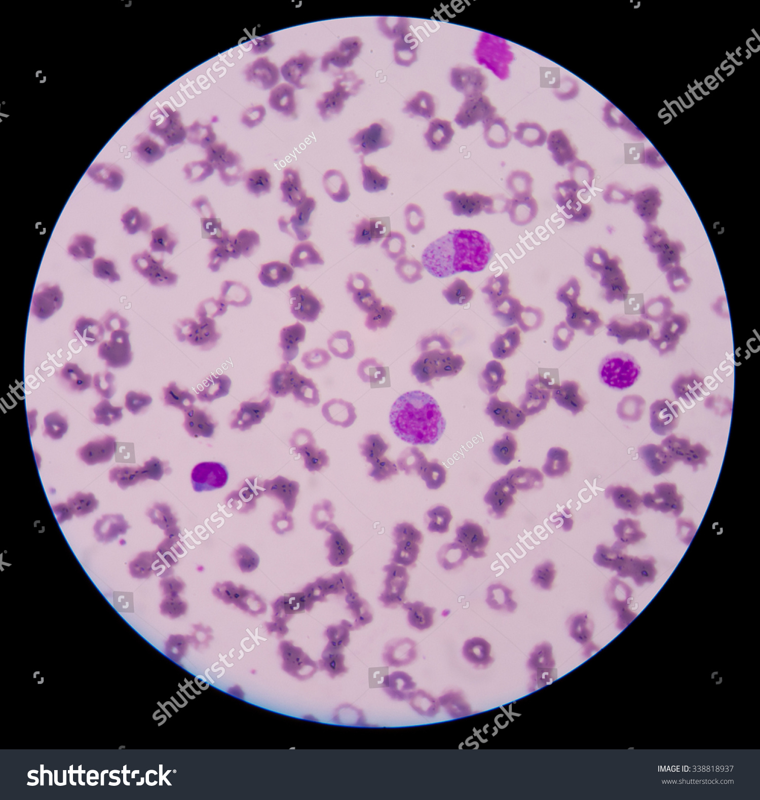 Abnormal Neutrophil. Stock Photo 338818937 : Shutterstock