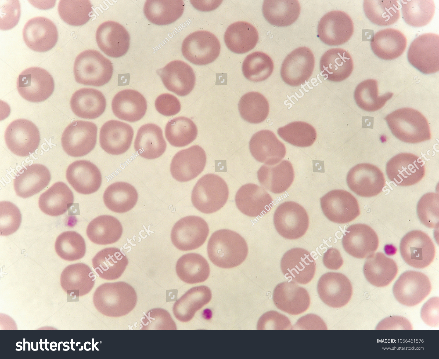 Abnormal Red Blood Cells Thalassemia Patient Stock Photo 1056461576 ...