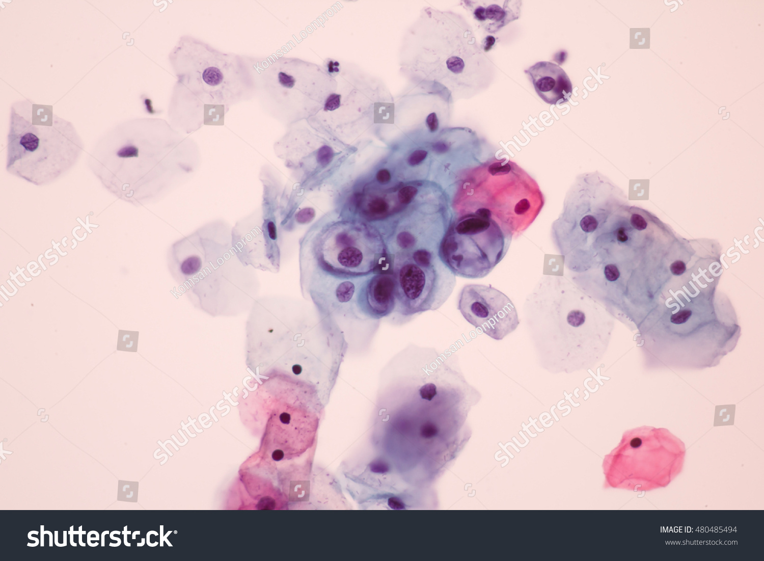 hpv abnormal squamous cells