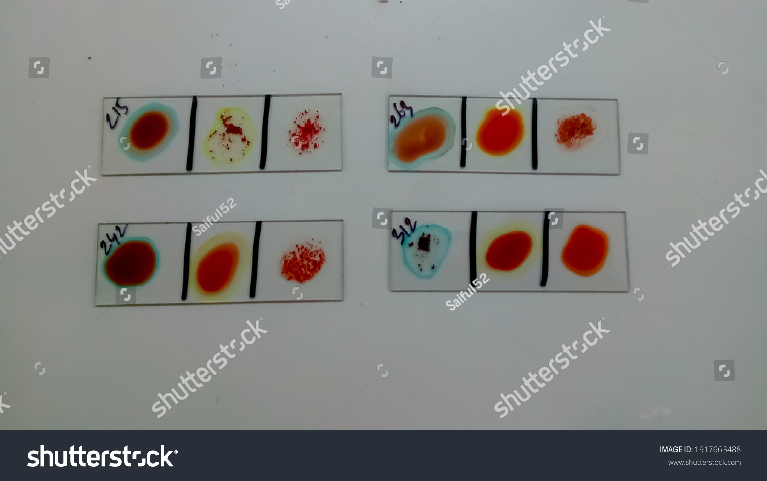 Abo Blood Grouping By Slide Test Stock Photo (Edit Now) 1917663488