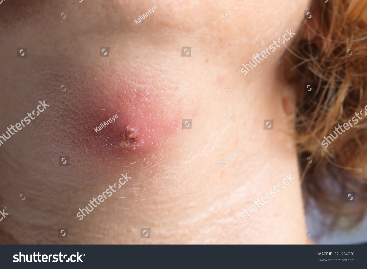 abscess under chin area suppuration collection stock photo edit now