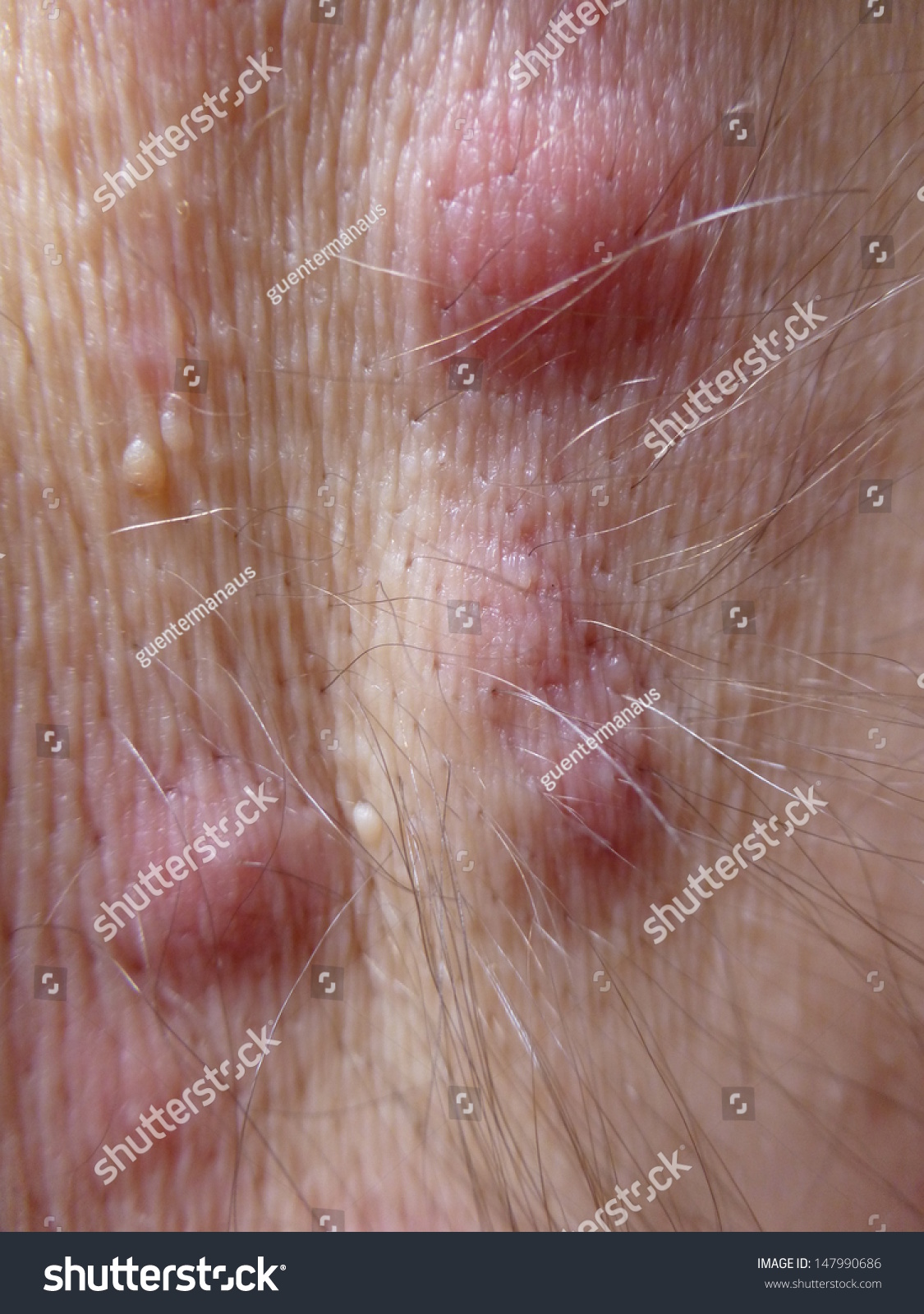 Acne Inversa, Hidradenitis Suppurativa In The Armpit Stock Photo ...