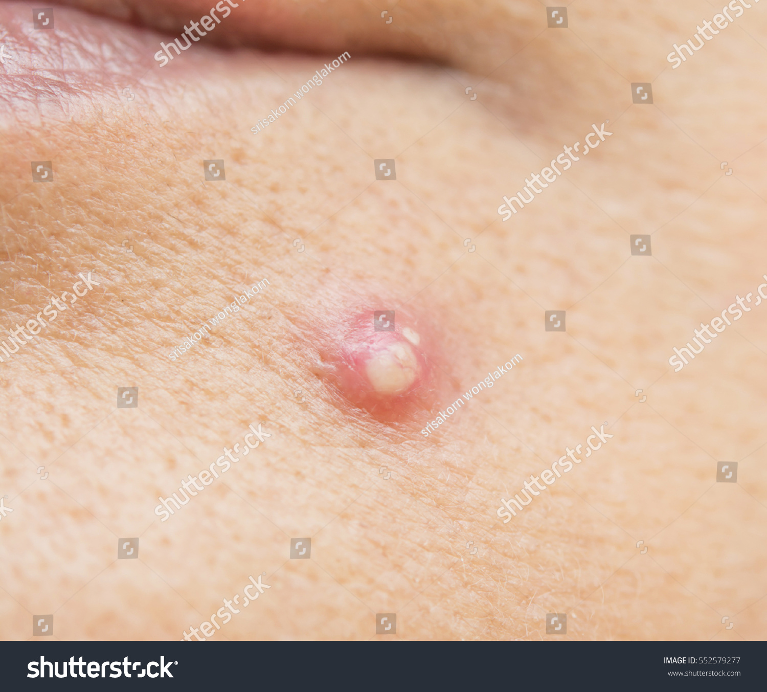 Acne Pus On Face Acne Pus On Face