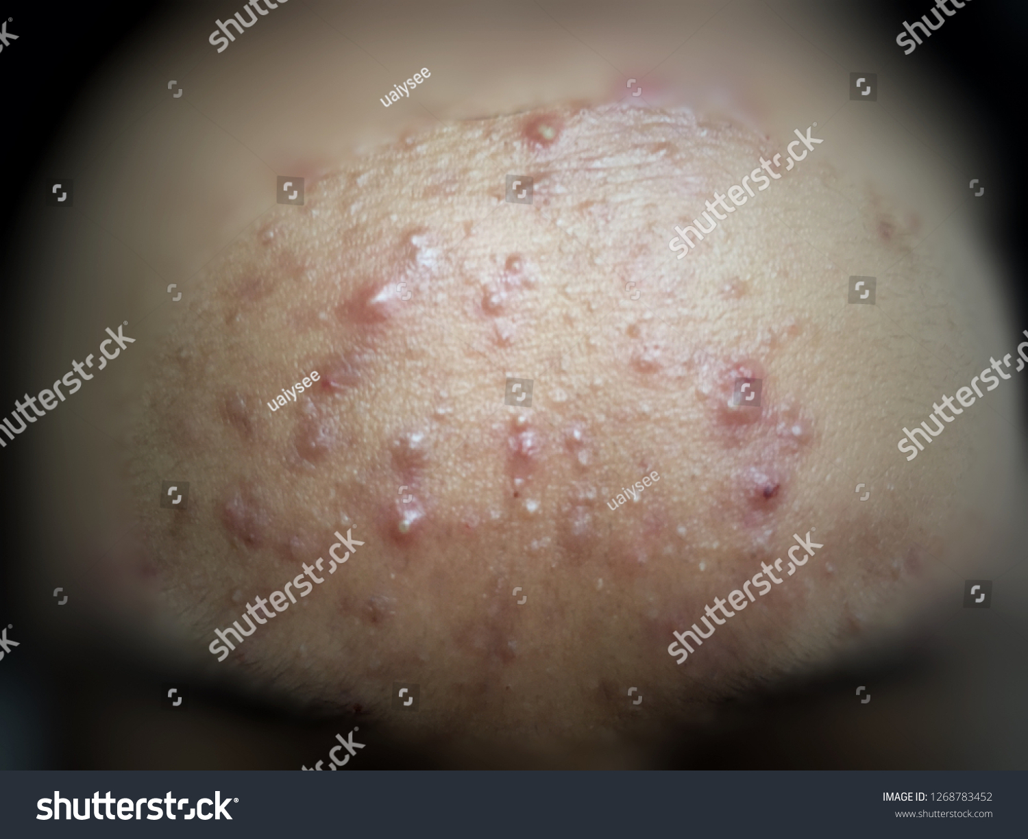 Acne Skin Because Disorders Sebaceous Glands Stock Photo Edit Now