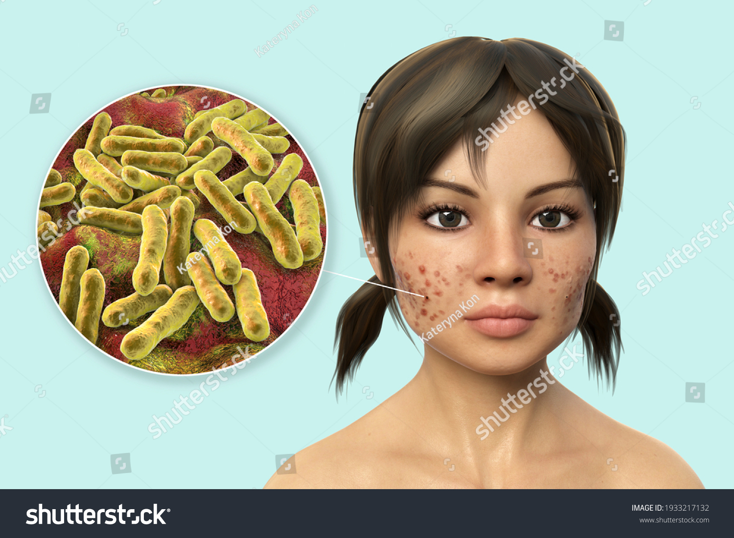 Acne Vulgaris On Skin Closeup View Stock Illustration 1933217132