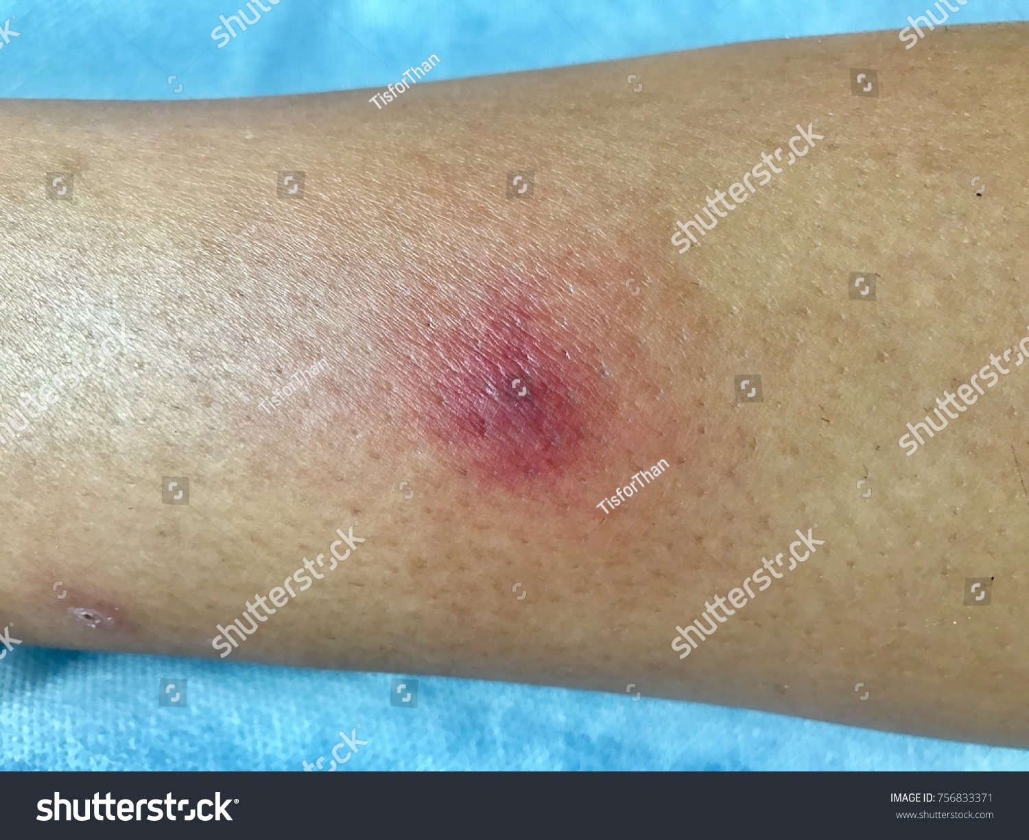 Acute Bacterial Folliculitis After Insects Bitten Stock Photo Edit Now