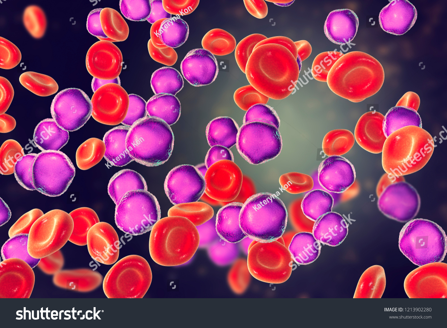 Acute Lymphoblastic Leukemia Bone Marrow Smear ภาพประกอบสต็อก 1213902280 Shutterstock