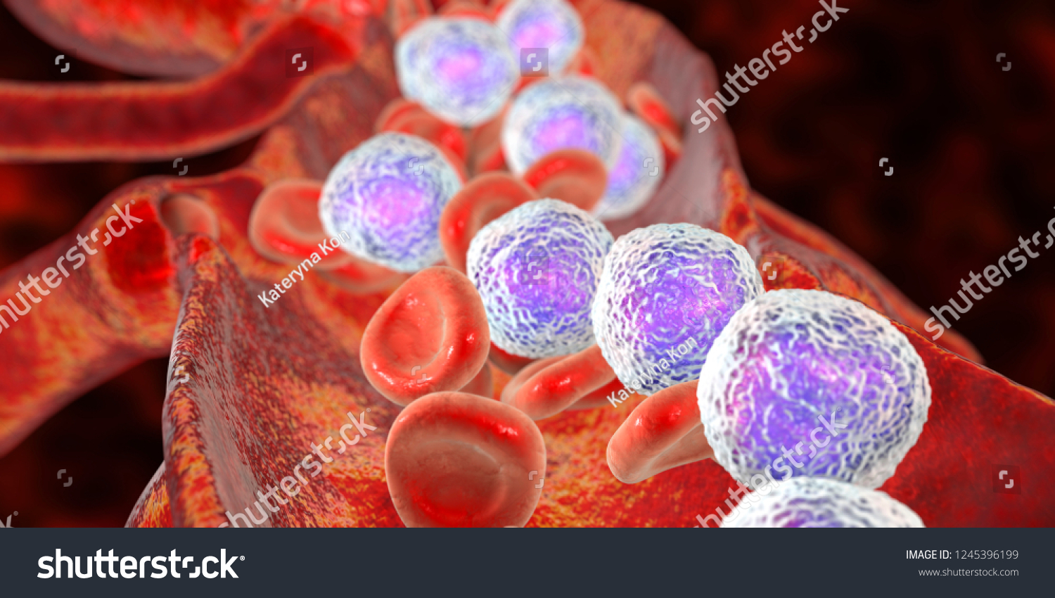 Leucemia Linfoblástica Aguda, Ilustración 3D Que: Ilustración De Stock ...