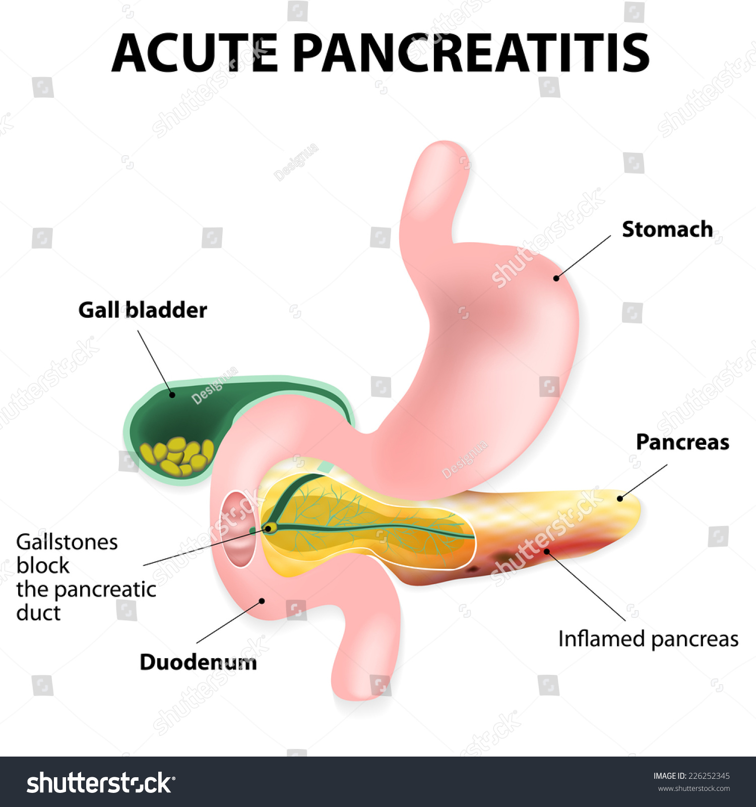 Acute Pancreatitis Inflammation Pancreas Gallstones Block Stock Illustration 226252345 9333