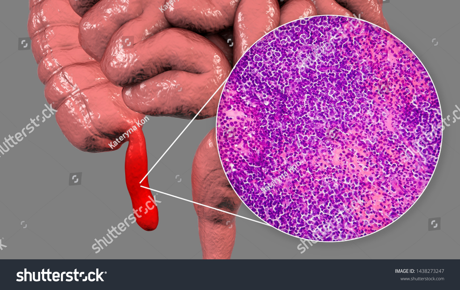 Acute Suppurative Appendicitis 3d Illustration Human 스톡 일러스트 1438273247 Shutterstock