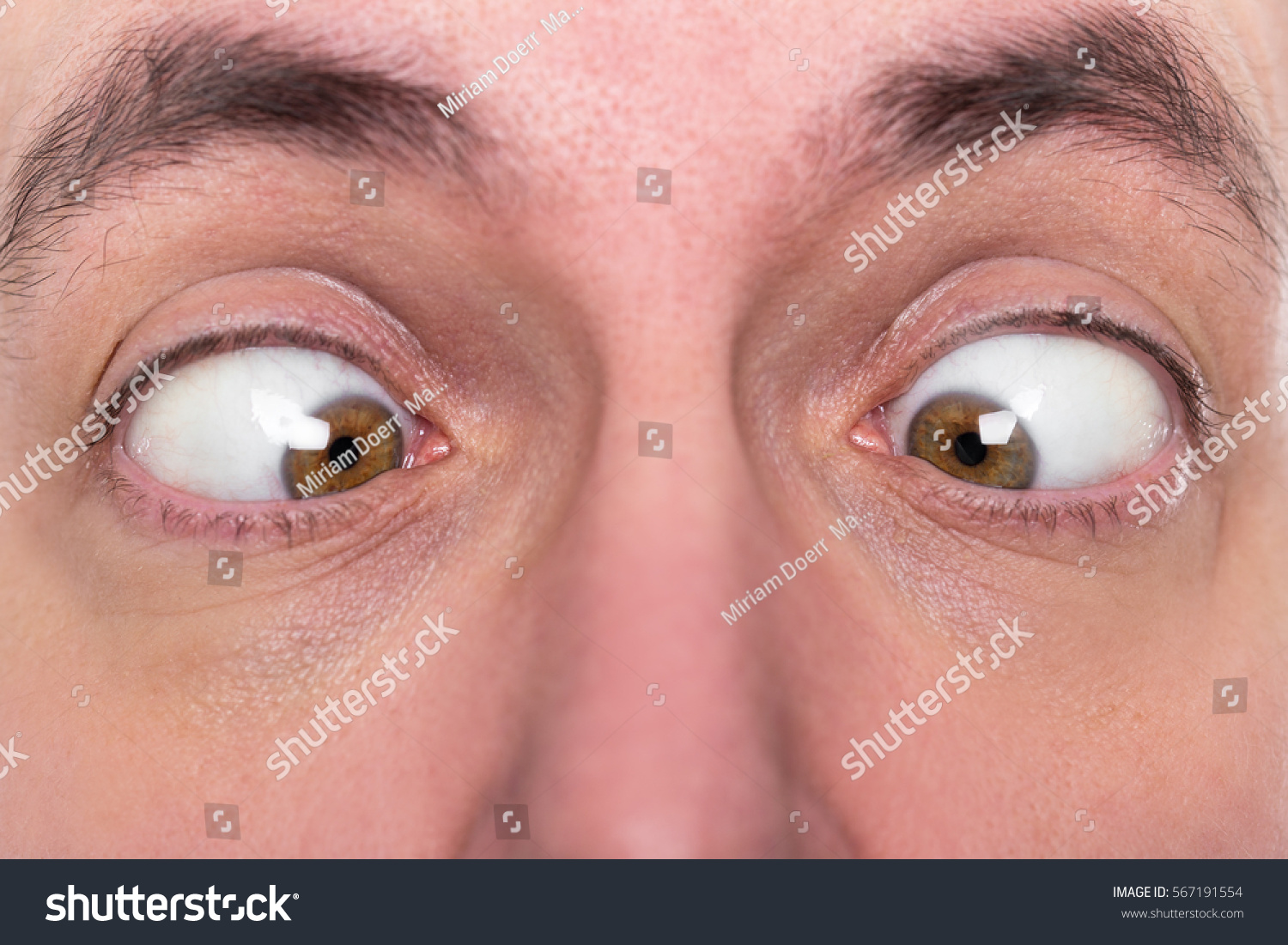 Why does strabismus appear in adults and how to be treated (from surgery to traditional methods) Why does strabismus appear in adults and how to be treated (from surgery to traditional methods)