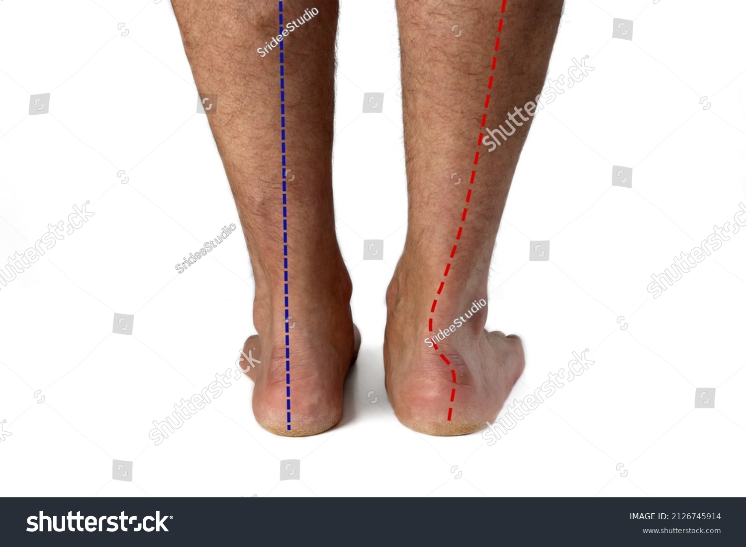 9-936-foot-condition-images-stock-photos-vectors-shutterstock