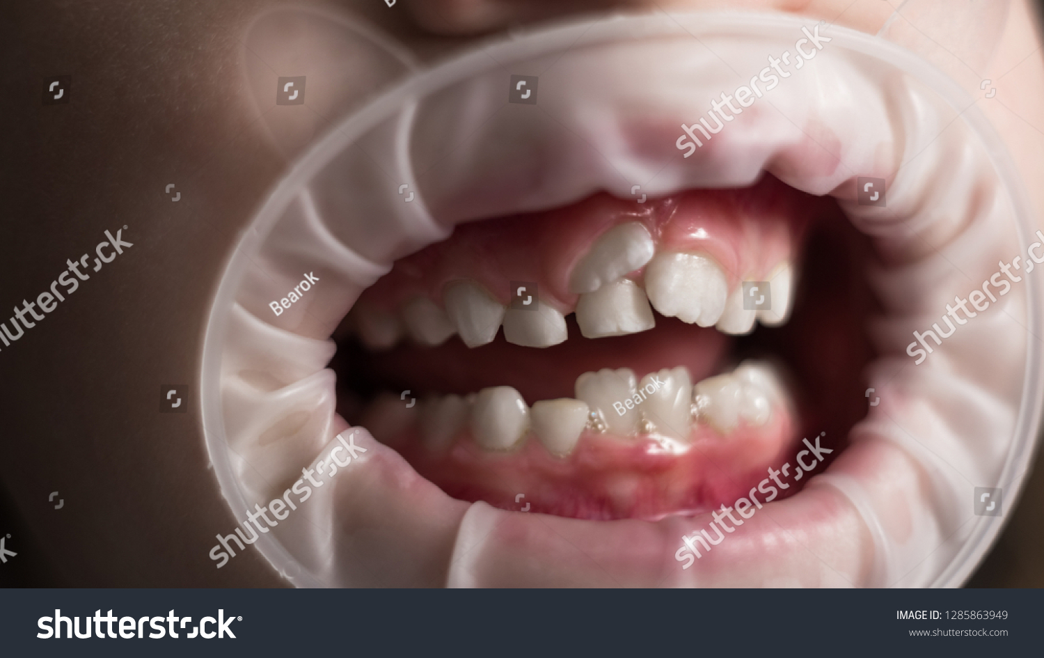 Adult Permanent Teeth Coming Front Childs Foto De Stock 1285863949 ...