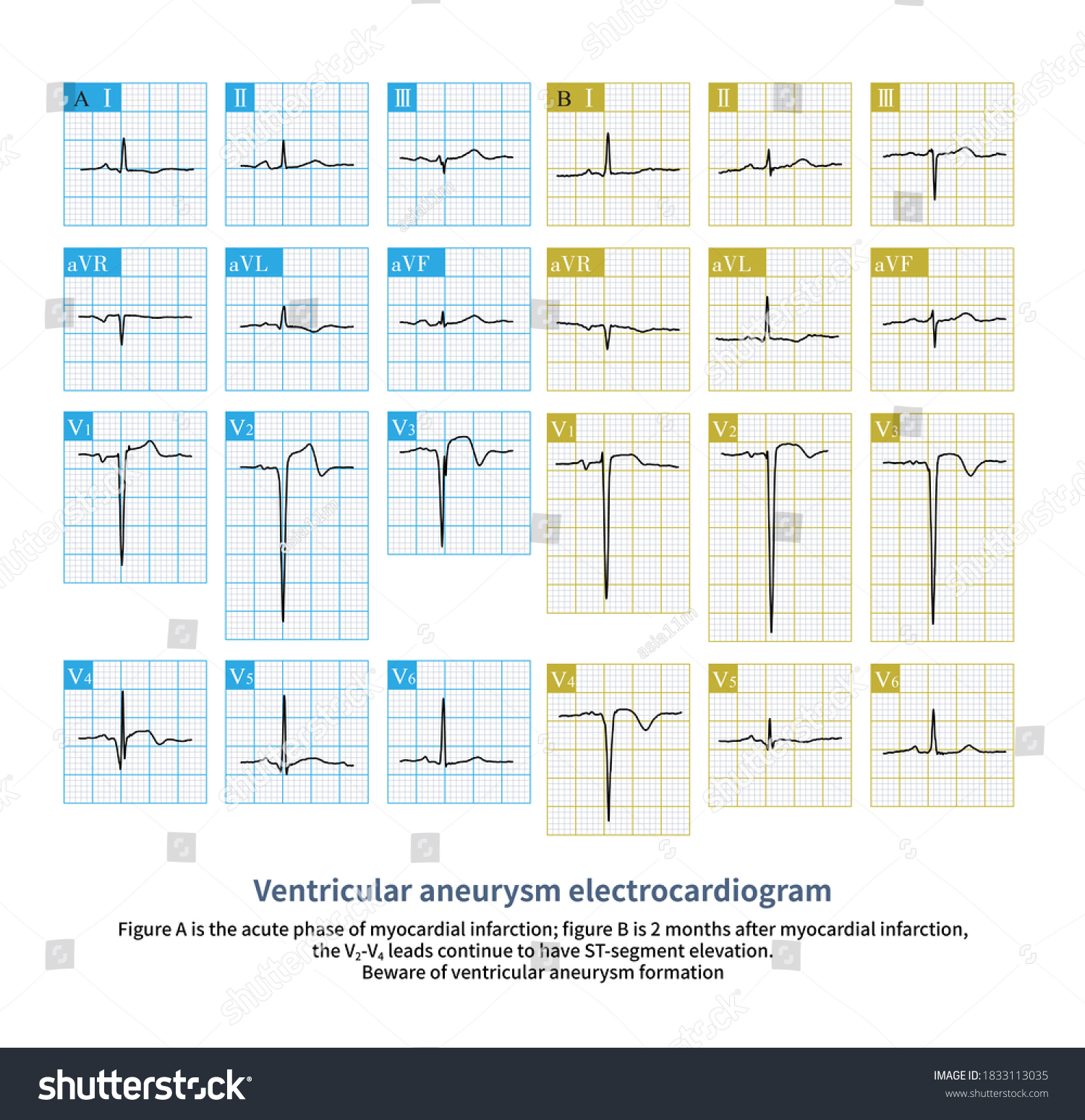 After Myocardial Infarction Continuous Stsegment Elevation Stock ...