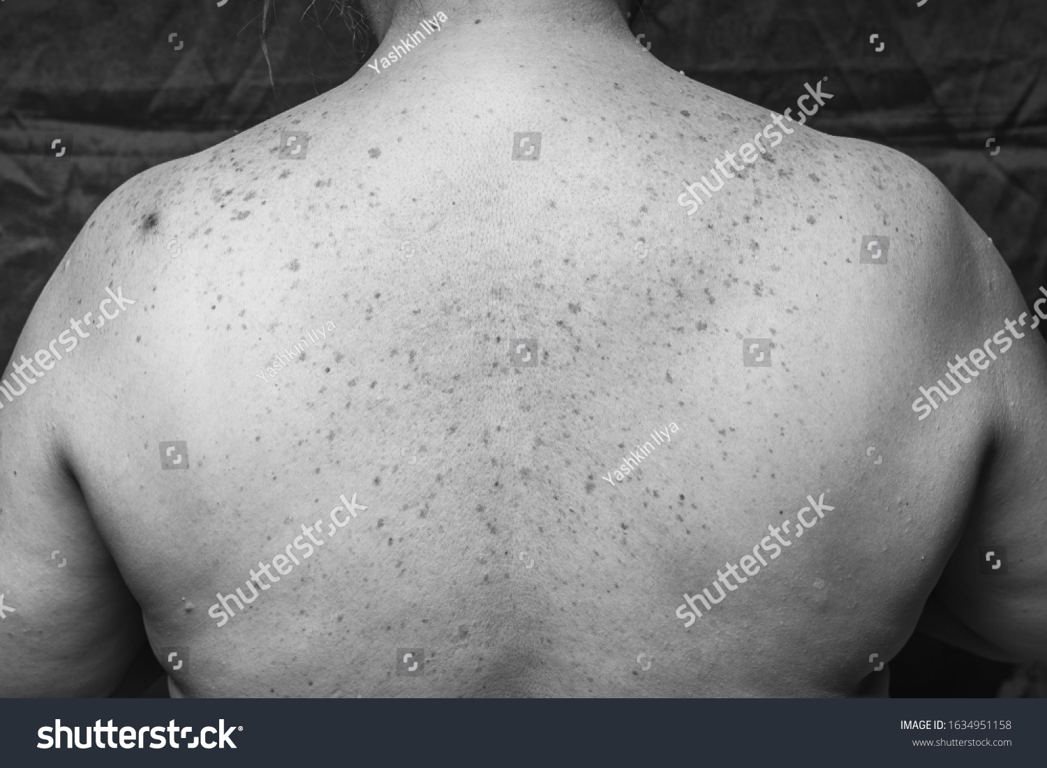 Age Spots Moles Freckles On Back Stock Photo (Edit Now) 1634951158