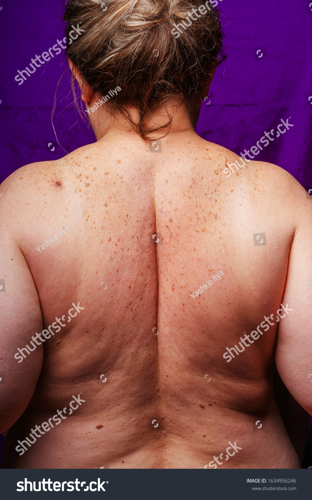 Age Spots Moles Freckles On Back Stock Photo Edit Now