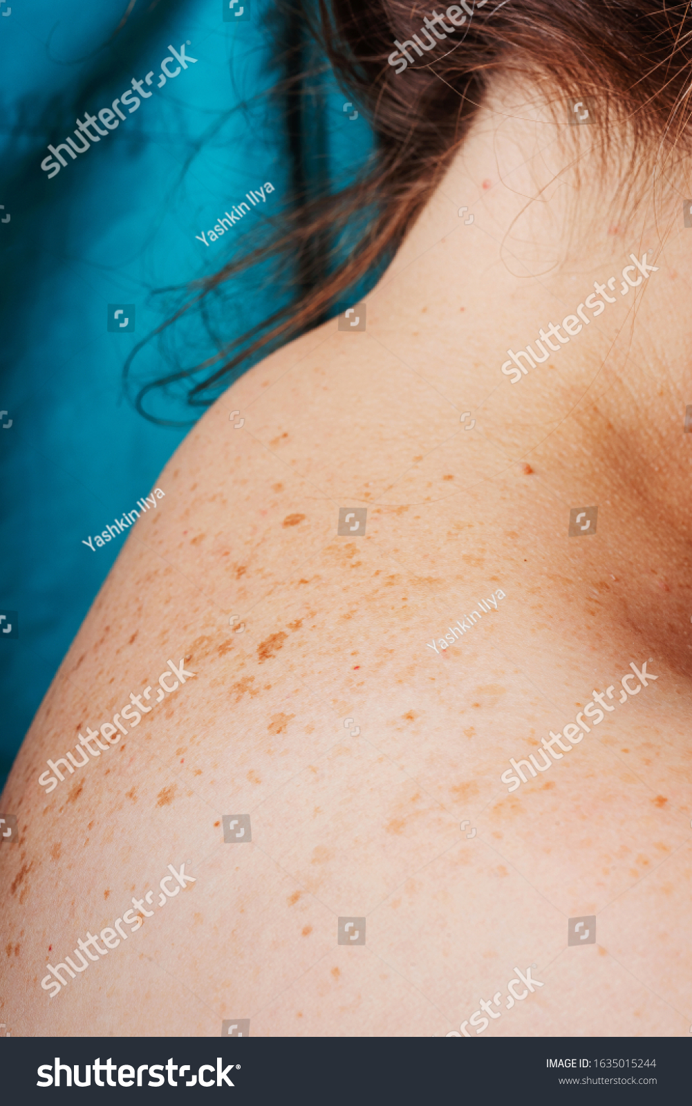 Age Spots Moles Freckles On Shoulders Stock Photo (Edit Now) 1635015244