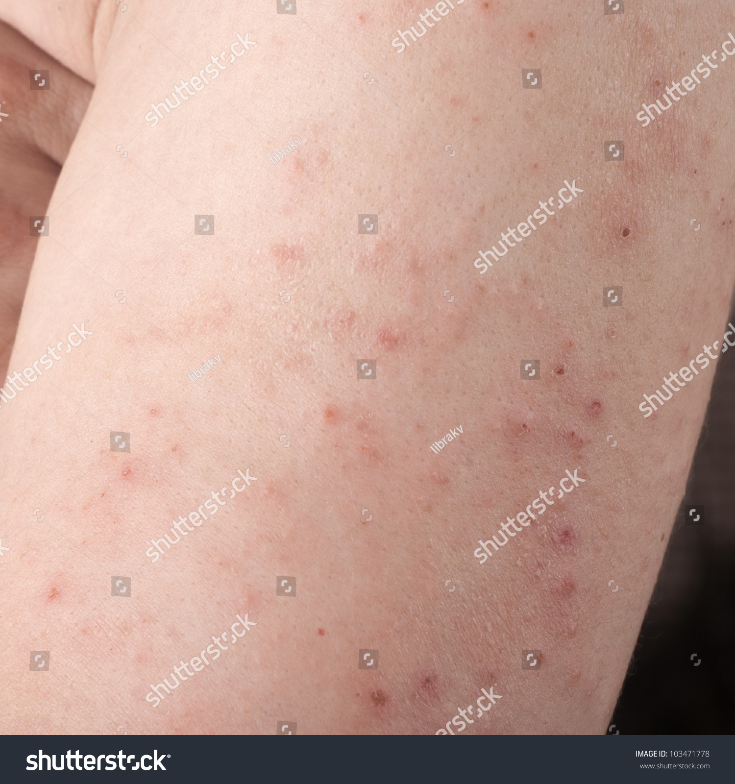 Allergic Rash Dermatitis Back Skin Patient Stock Photo 103471778