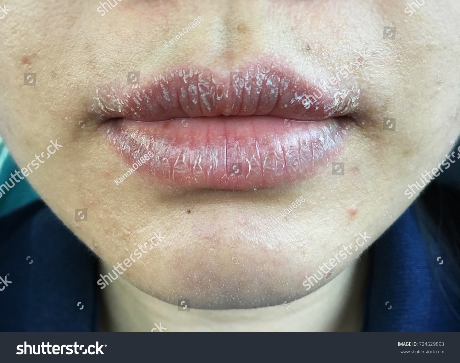 Allergic Reaction On Child Women Mouth Stock Photo Edit Now 724529893