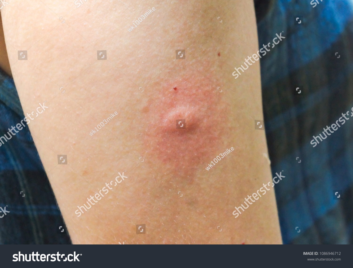 Foto Stok Allergic Reaction Mosquito Bites Edit Sekarang 1086946712