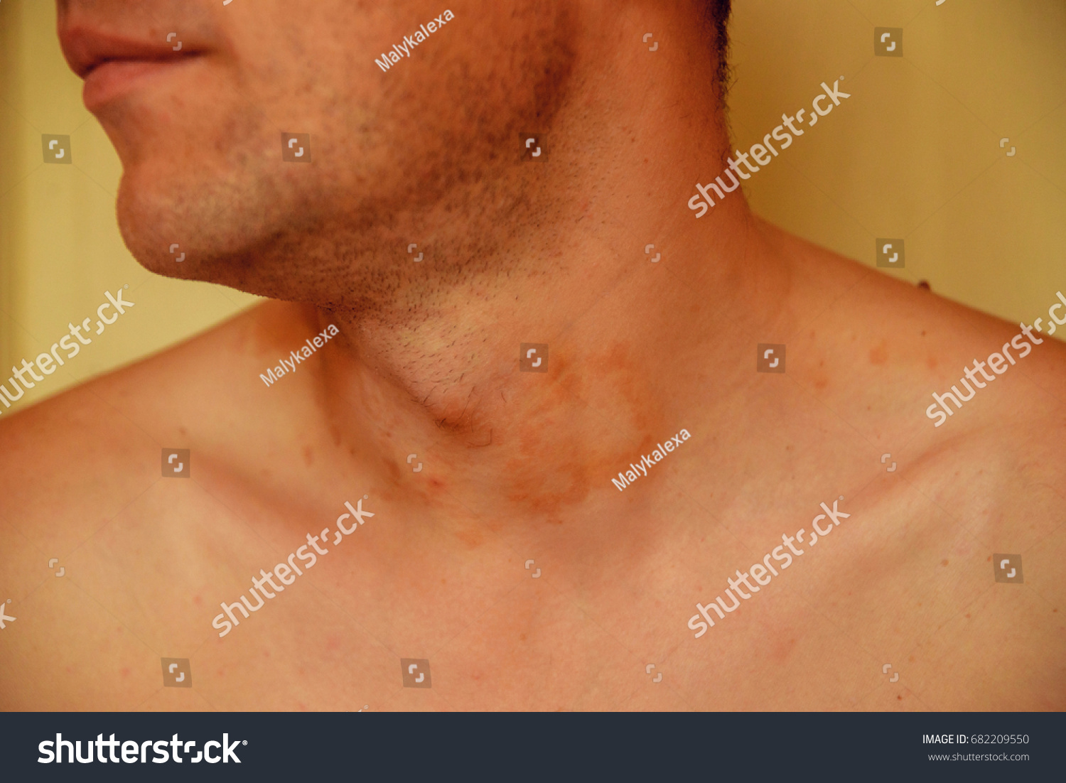 allergic-skin-rash-spots-on-neck-foto-stok-682209550-shutterstock