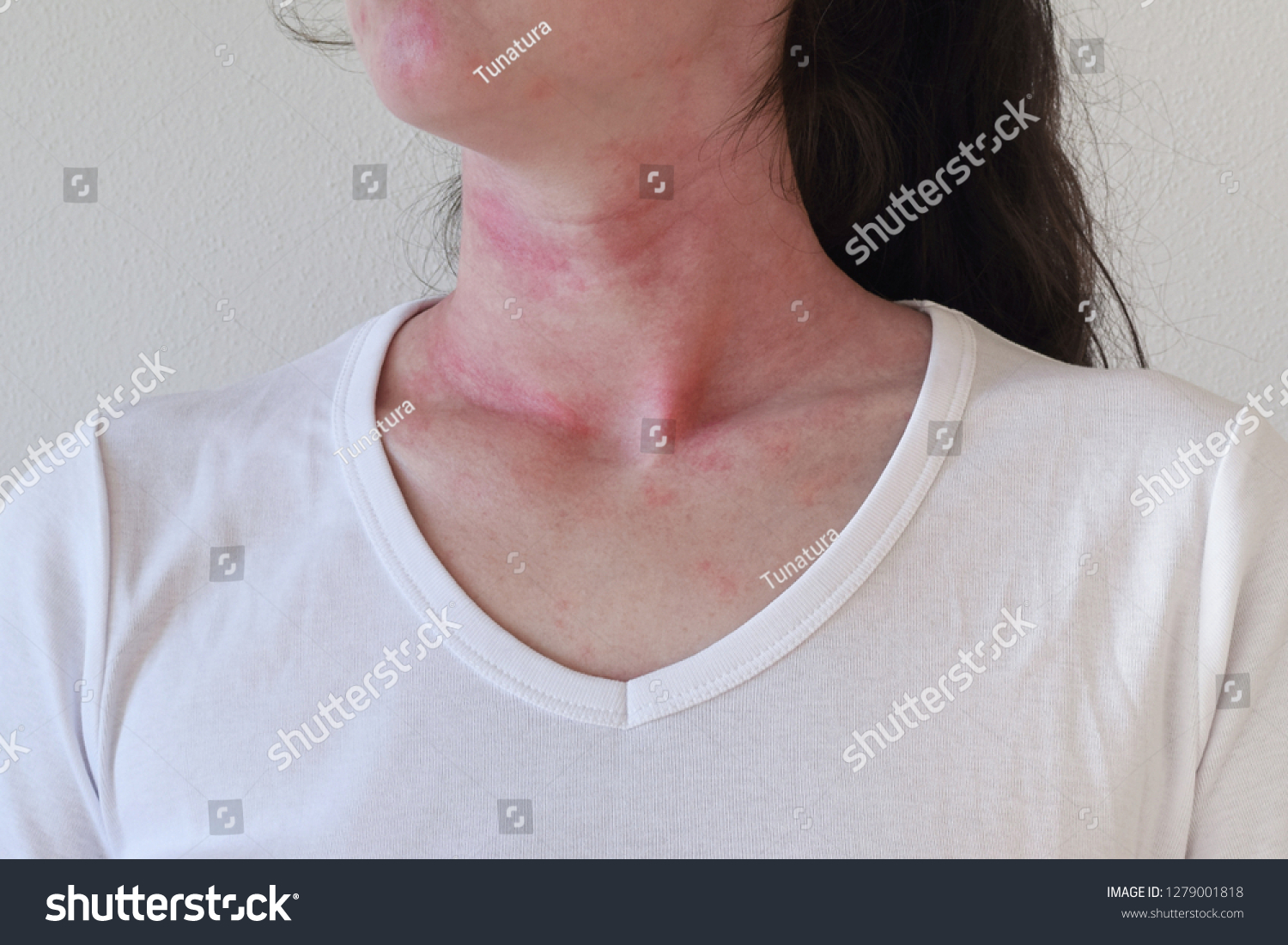 Allergic reaction Images, Stock Photos & Vectors Shutterstock