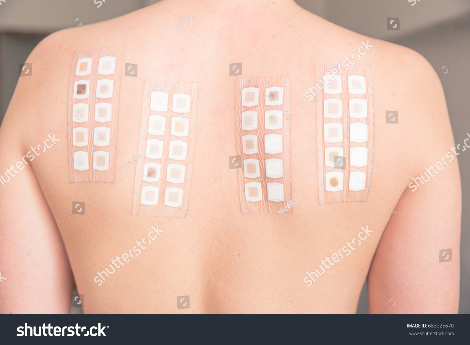 Allergy Patch Test On Back Female Stock Photo 683925670 | Shutterstock