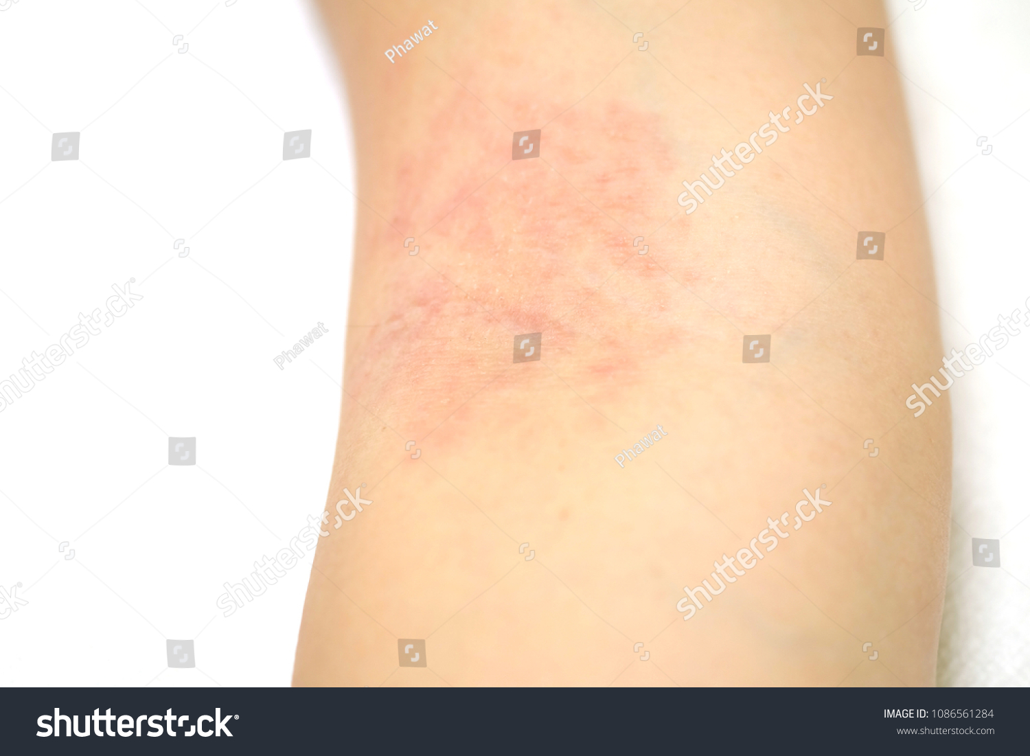 Allergy Red Rash On Arm Woman Stock Photo 1086561284 | Shutterstock