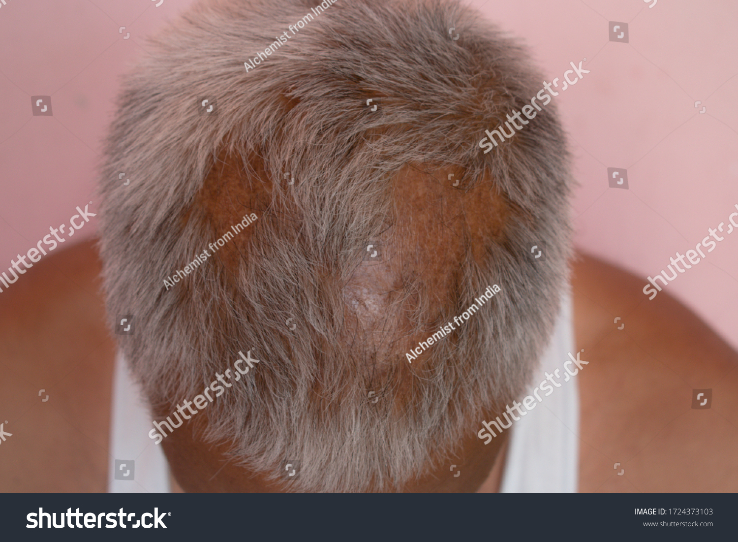 29 Patchy Bald Images Stock Photos Vectors Shutterstock 29-patchy-bald-images-stock-photos-vectors-shutterstock