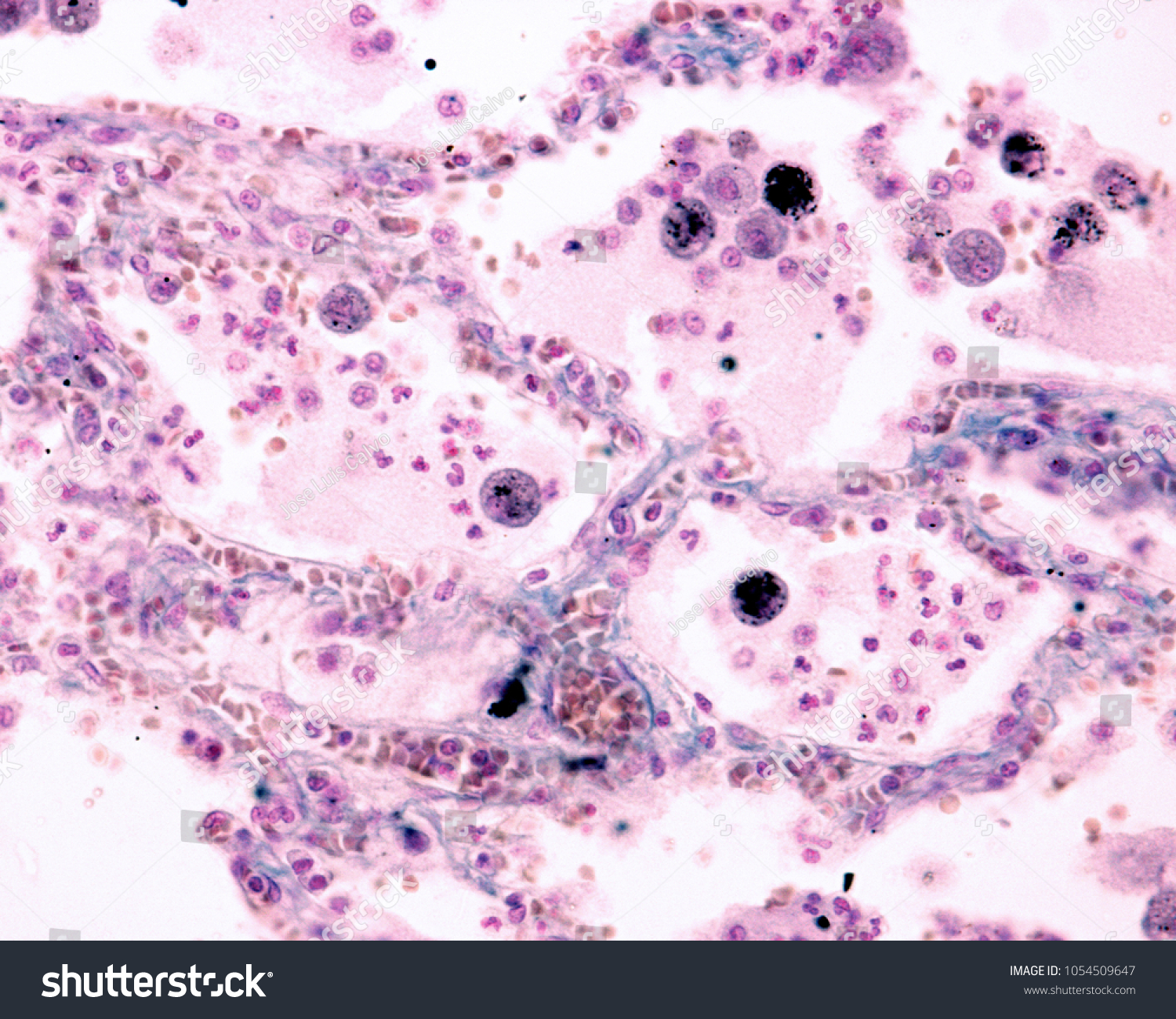 Alveolar Macrophages Polymorphonuclear Neutrophils Alveolar Lumen Stock Photo Edit Now 1054509647