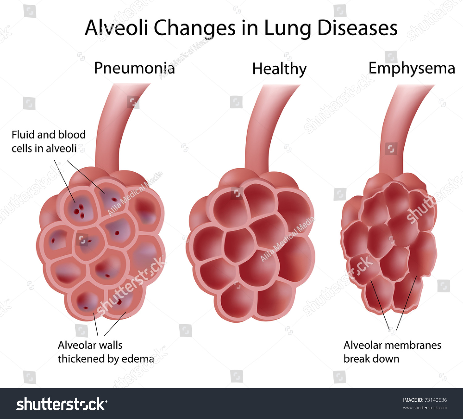 Alveoli Lung Diseases Stock Illustration 73142536 - Shutterstock