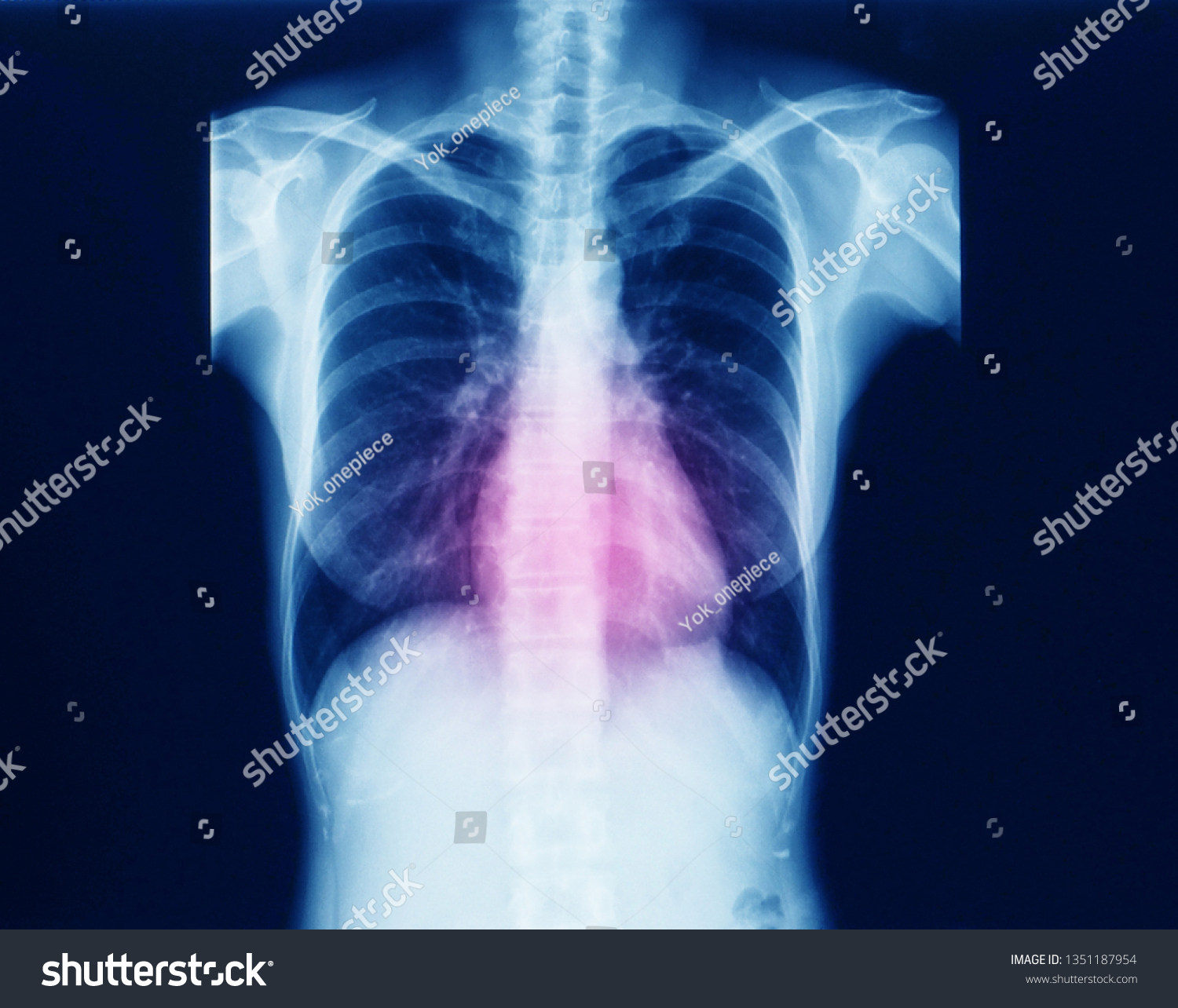 Anteroposterior Projection Xray Radiograph Chest Heart Stock Photo ...