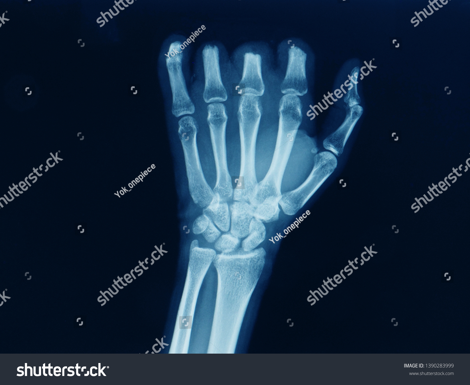 Anteroposterior Radiograph Xray Hand Showing Multiple Stock Photo Edit Now