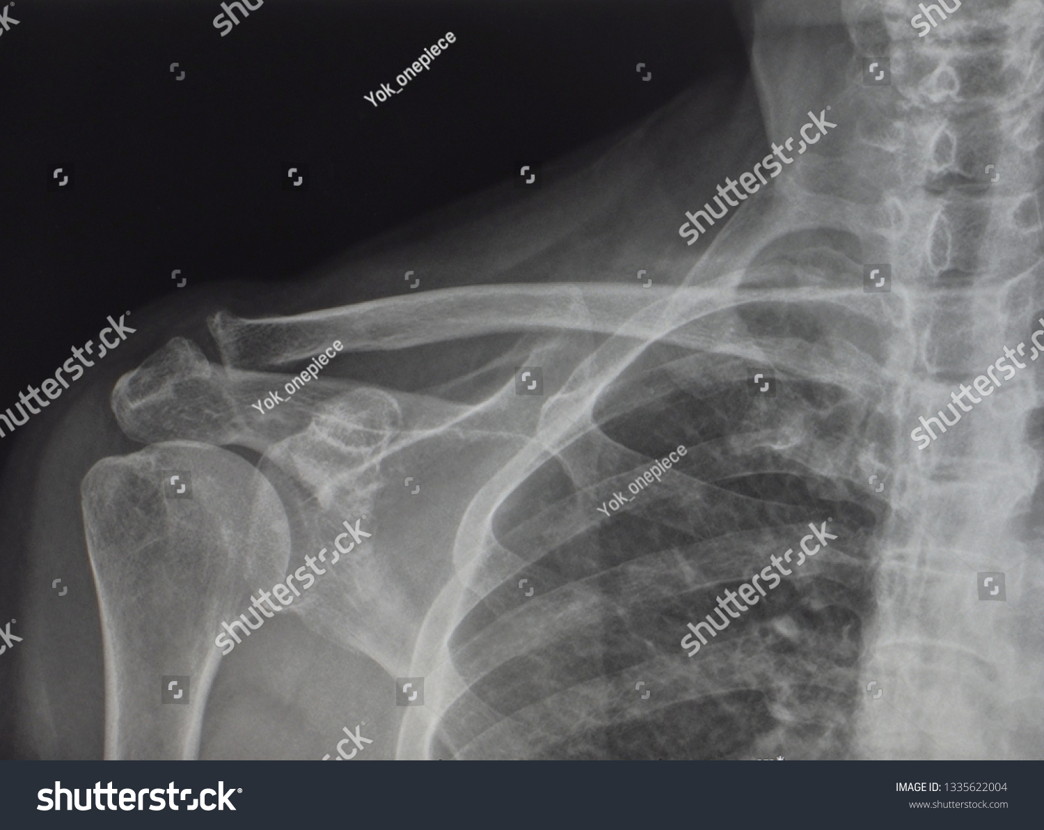 Anteroposterior Radiograph Xray Shoulder Showing Normal Stock Photo Shutterstock