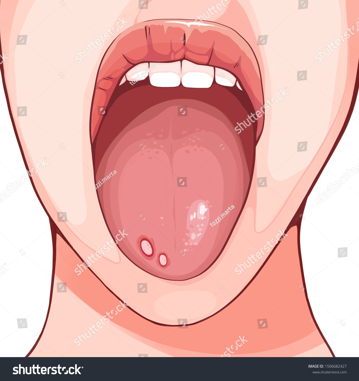 Aphthous Ulcer Typically Recurrent Round Oval стоковая иллюстрация