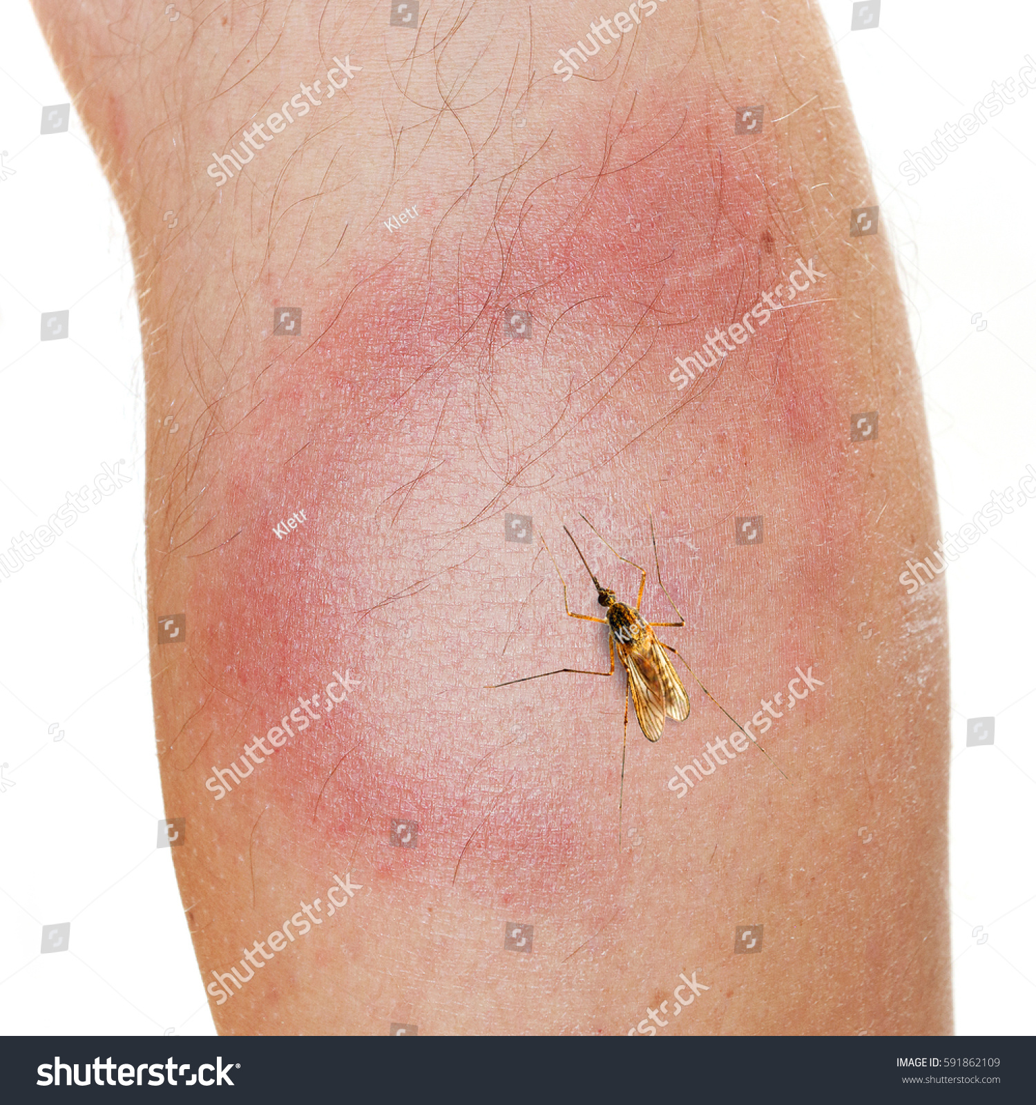 Erythema Migrans Rash Often Seen Early Stock Photo 591862109 - Shutterstock