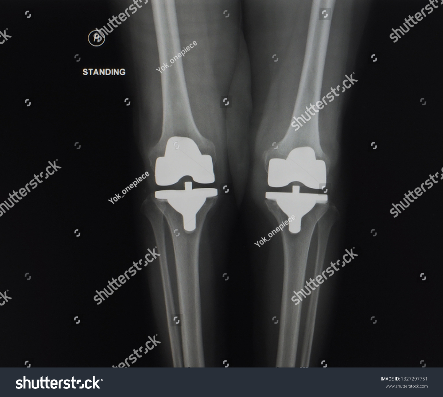 Image Bilateral Total Knee Arthroplasty Replacement Stock Photo ...