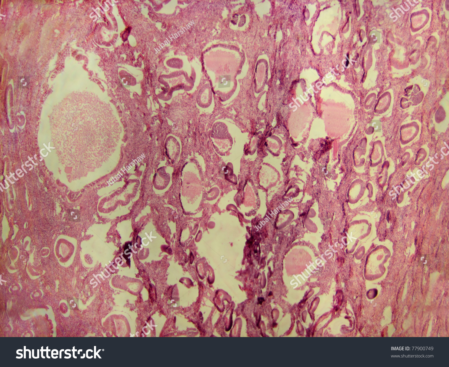 Overview Tissue Human Ovarian Polyp Magnification Stock Photo 77900749 ...