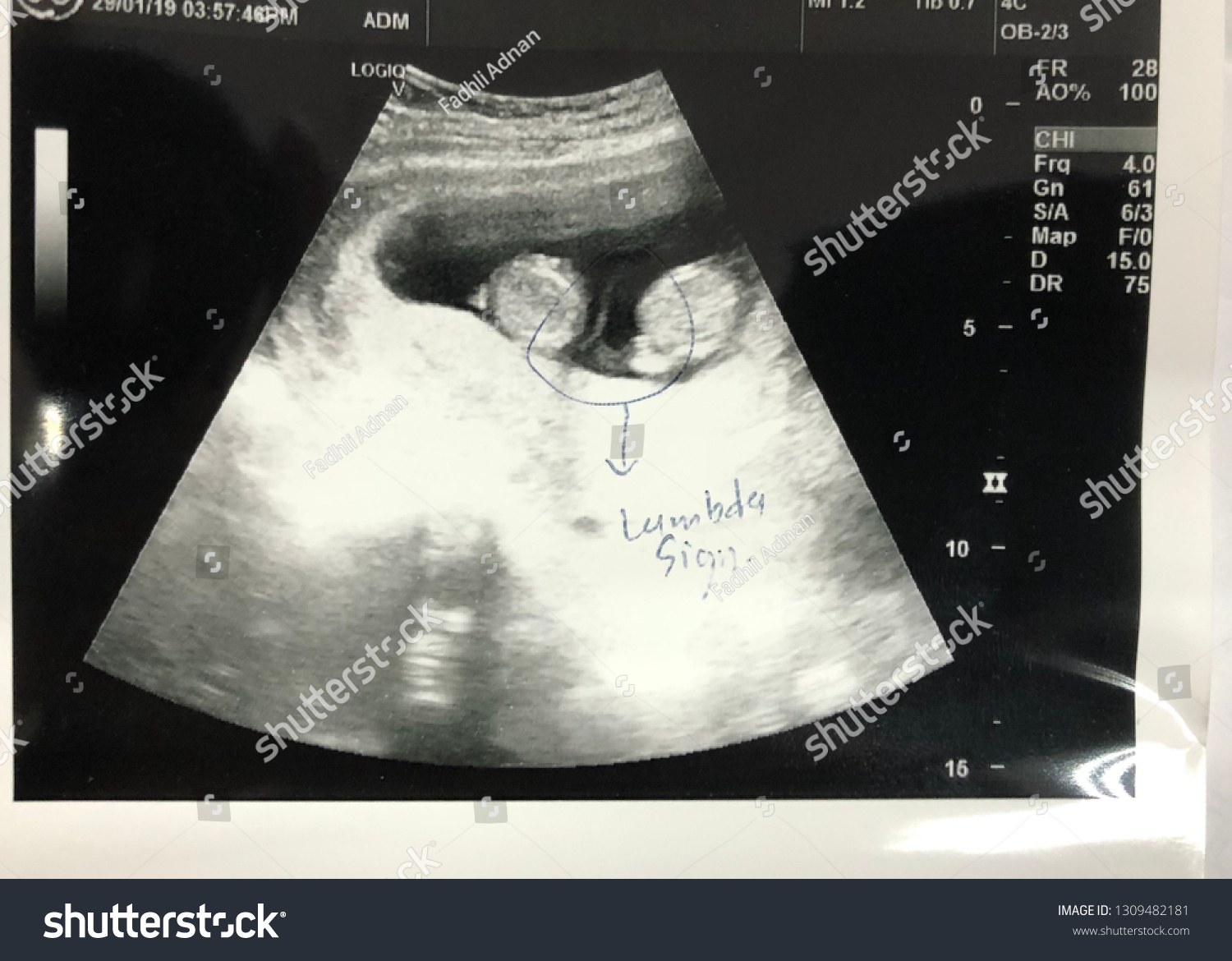 Images twin pregnancy ultrasound Mare Ultrasound