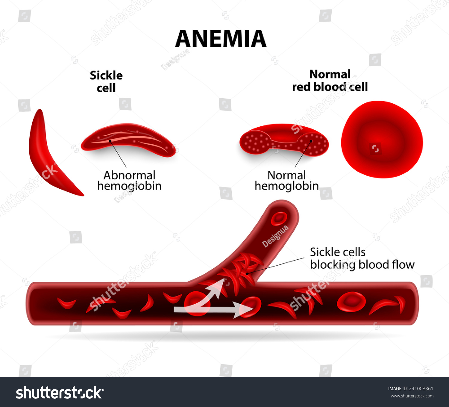 Sickle Cell Anemia Vs Normal Blood Cells