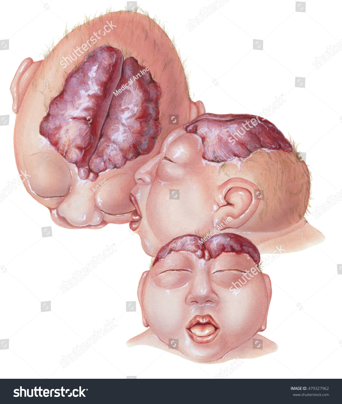 無脳症 複数の観点 脳と頭蓋骨の大部分が欠けていること 胎児の発達の早い段階で発生します ニューラルチューブの上部が閉じられない場合に発生する のイラスト素材
